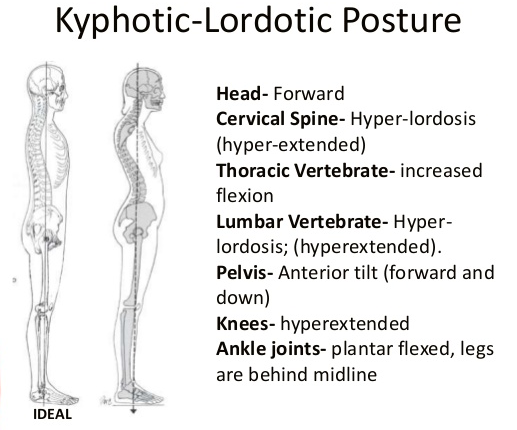 kyphosis-lordosis-points.png#s-517,430